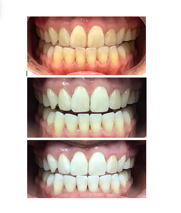 before and after teeth whitening case study