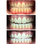 before and after teeth whitening case study