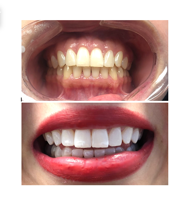 before and after teeth whitening case study