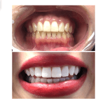 before and after teeth whitening case study