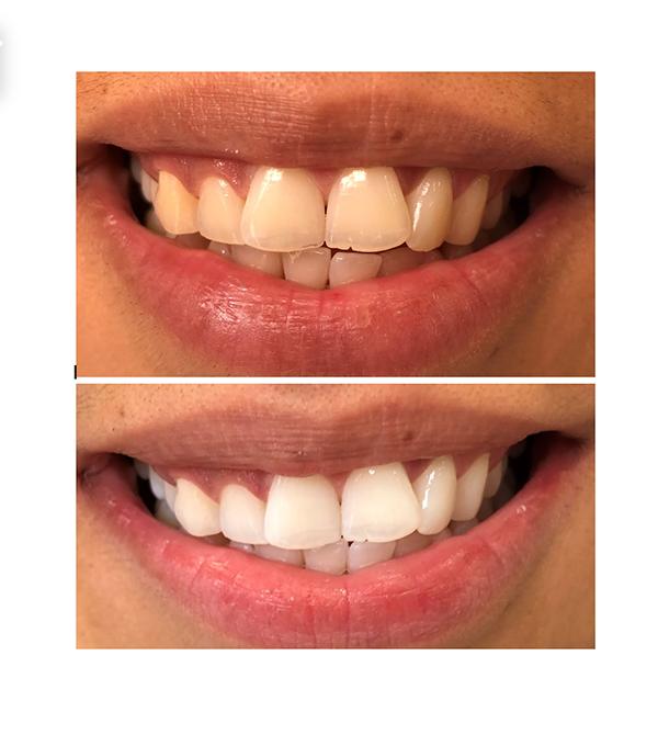 before and after teeth whitening case study