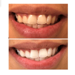 before and after teeth whitening case study