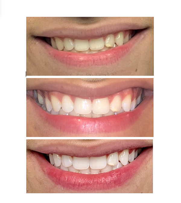 before and after teeth whitening case study