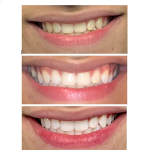 before and after teeth whitening case study