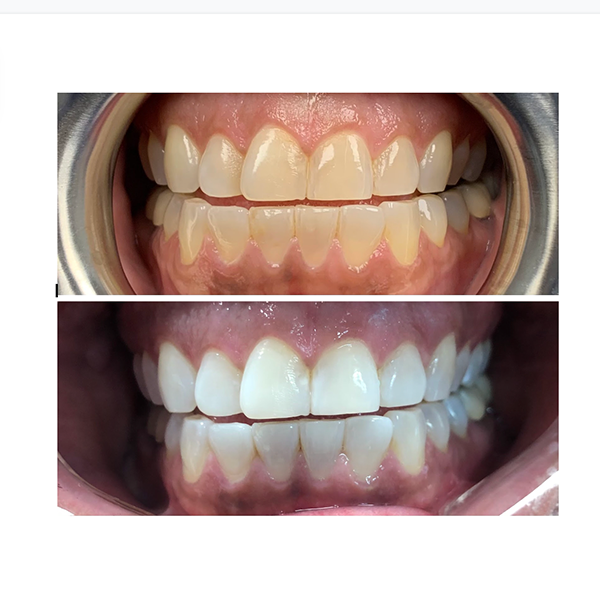 before and after teeth whitening case study