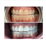before and after teeth whitening case study