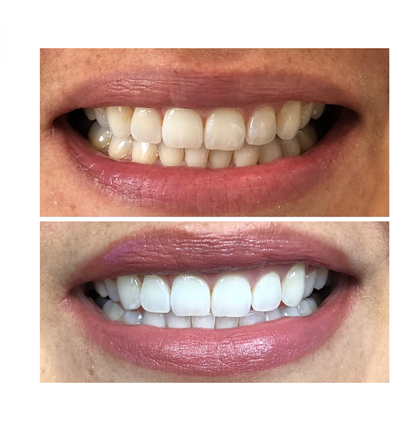 before and after teeth whitening case study