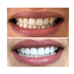 before and after teeth whitening case study