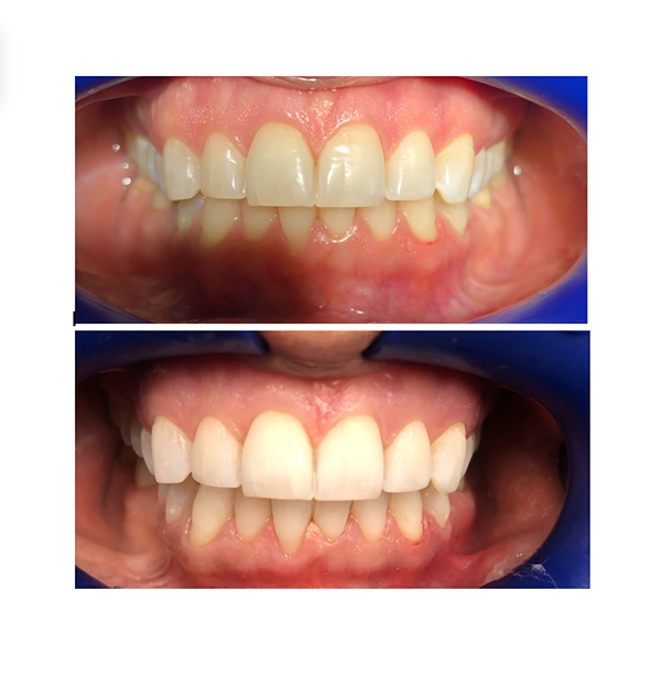 before and after teeth whitening case study