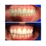 before and after teeth whitening case study
